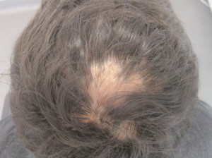 Alopecia areata and lechen on same person