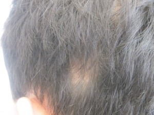 Alopecia areata and lechen on same person