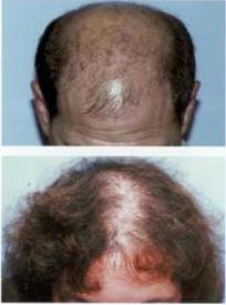 Androgenetic alopecia in men and women