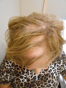 Alopecia areata (women)